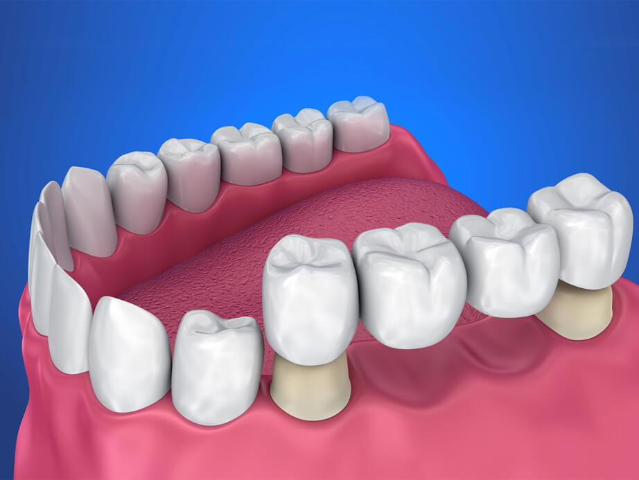 Dental Crowns