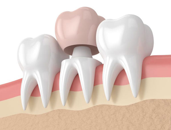 Dental Crowns