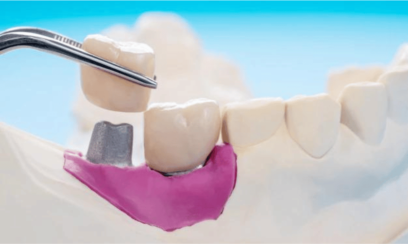 Featured image for “Common Misconceptions about Dental Crowns Debunked”
