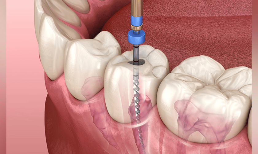 Featured image for “How to Prevent Plaque Build-up on a Root Canal”