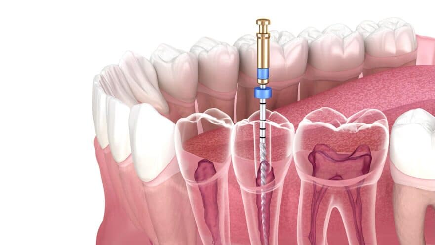 Root Canals in Sharpsville