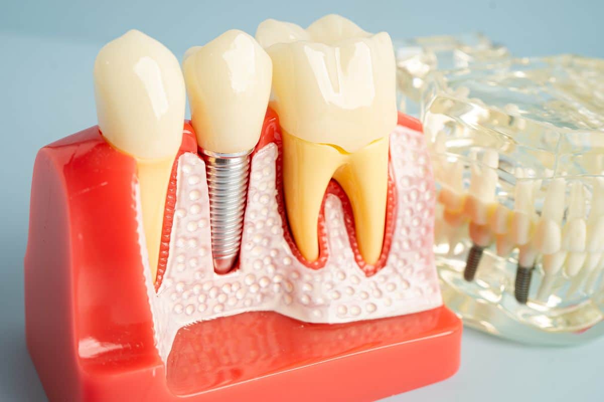 Featured image for “What Is the Typical Healing Time for Dental Implants?”
