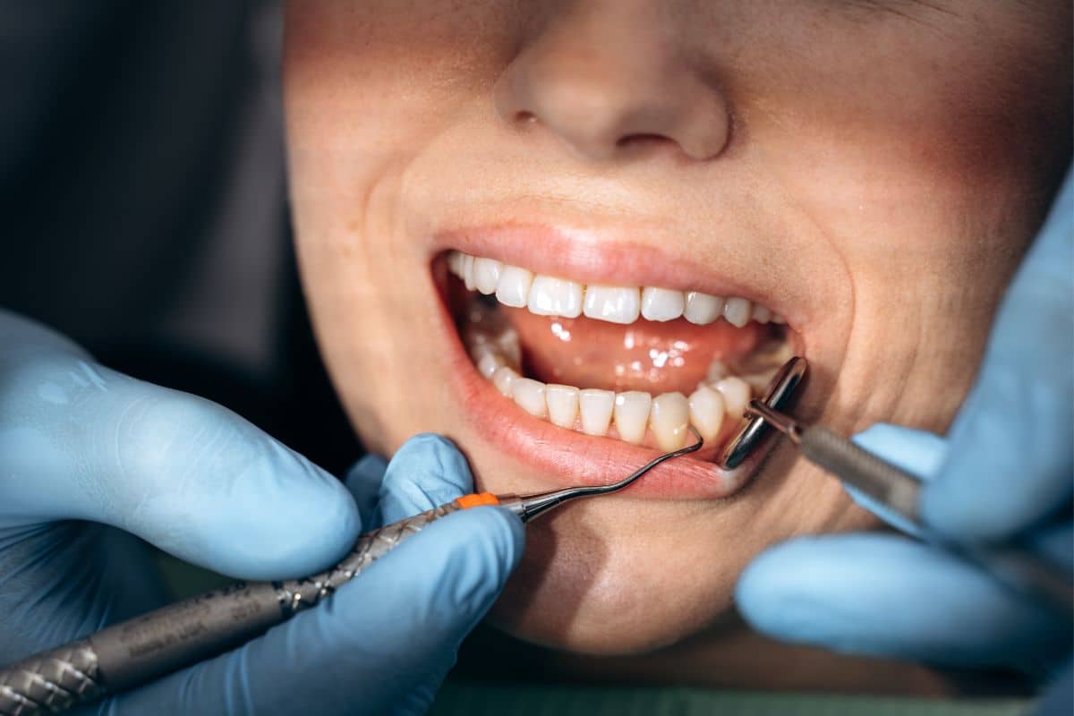 Featured image for “What Steps Does a Dentist Take to Remove Tooth Decay Safely?”