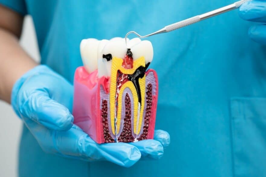 How Long Does Root Canal Recovery Take?