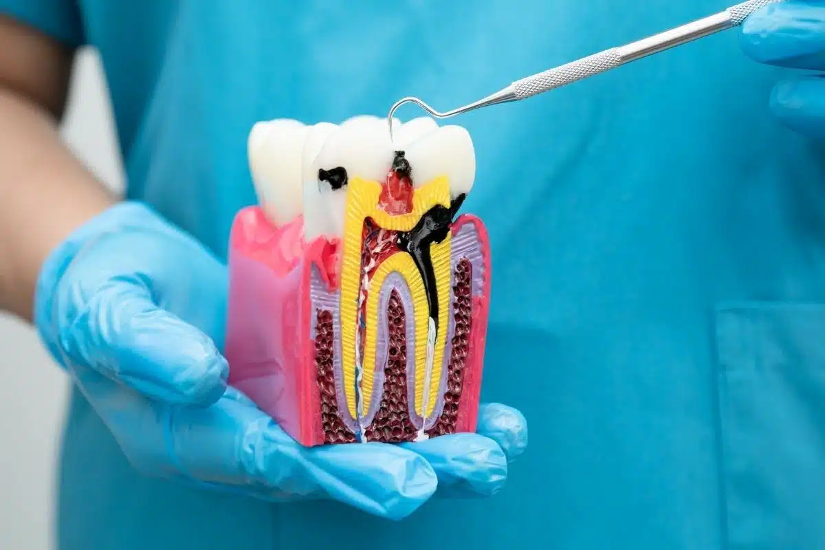 Featured image for “How Long Does Root Canal Recovery Take?”