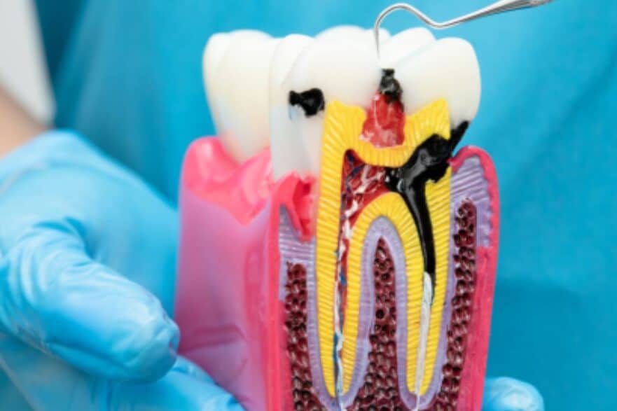 How Long Does a Tooth Last After a Successful Root Canal Treatment?